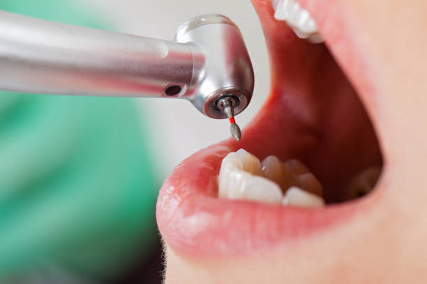 Best Emergency Dental Care for Broken or Chipped Teeth in Manton, MI